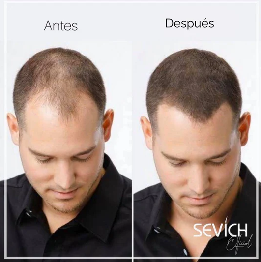 🥳ADIÓS A LOS PARCHES DE TU CABEZA O BARBA😎FIBRA CAPILAR✅