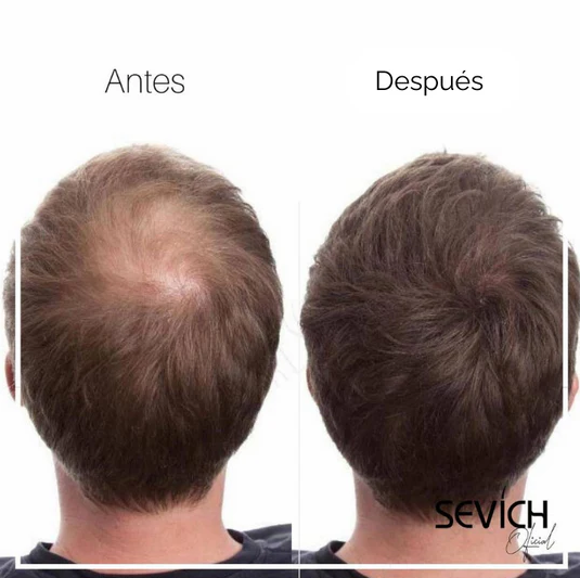 🥳ADIÓS A LOS PARCHES DE TU CABEZA O BARBA😎FIBRA CAPILAR✅