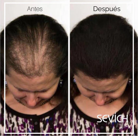 🥳ADIÓS A LOS PARCHES DE TU CABEZA O BARBA😎FIBRA CAPILAR✅